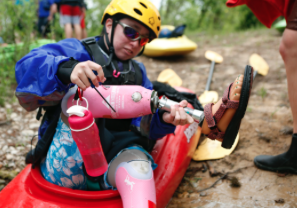 In pain and forced to use a wheelchair, a young woman opts to amputate her clubfeet